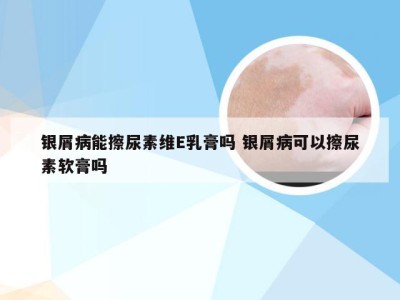 银屑病能擦尿素维E乳膏吗 银屑病可以擦尿素软膏吗