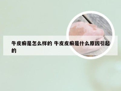 牛皮癣是怎么样的 牛皮皮癣是什么原因引起的