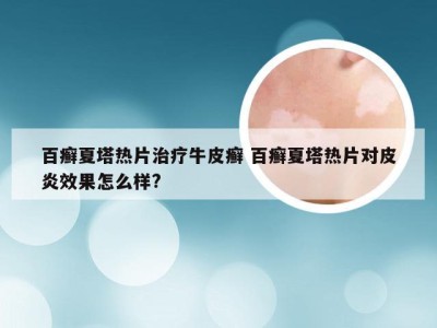 百癣夏塔热片治疗牛皮癣 百癣夏塔热片对皮炎效果怎么样?