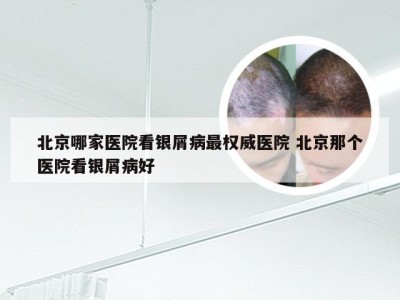 北京哪家医院看银屑病最权威医院 北京那个医院看银屑病好