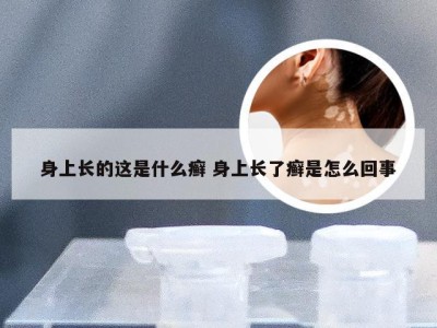 身上长的这是什么癣 身上长了癣是怎么回事