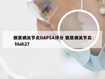 银屑病关节炎DAPSA评分 银屑病关节炎 hlab27