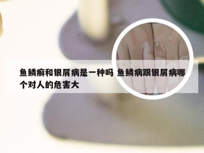 鱼鳞癣和银屑病是一种吗 鱼鳞病跟银屑病哪个对人的危害大