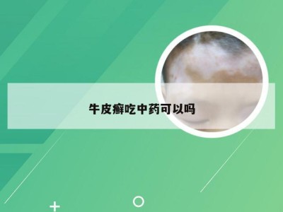 牛皮癣吃中药可以吗