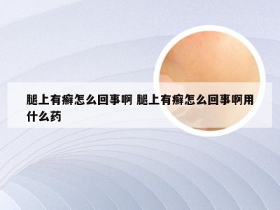 腿上有癣怎么回事啊 腿上有癣怎么回事啊用什么药