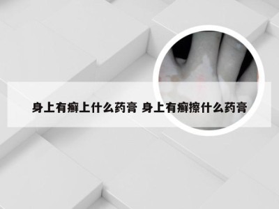 身上有癣上什么药膏 身上有癣擦什么药膏