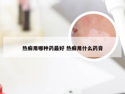 热癣用哪种药最好 热癣用什么药膏