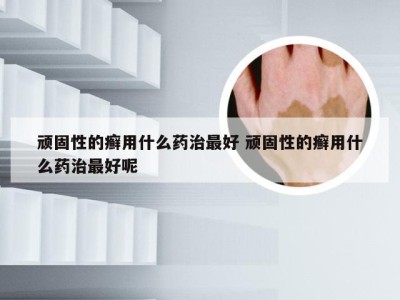 顽固性的癣用什么药治最好 顽固性的癣用什么药治最好呢