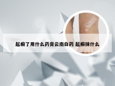 起癣了用什么药膏云南白药 起癣抹什么