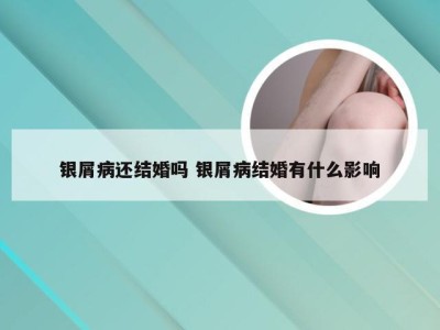 银屑病还结婚吗 银屑病结婚有什么影响