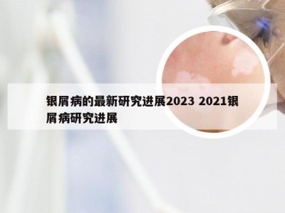 银屑病的最新研究进展2023 2021银屑病研究进展