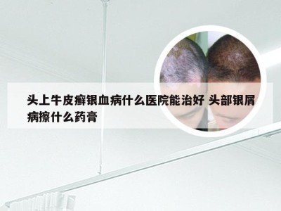 头上牛皮癣银血病什么医院能治好 头部银屑病擦什么药膏