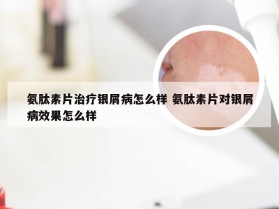 氨肽素片治疗银屑病怎么样 氨肽素片对银屑病效果怎么样