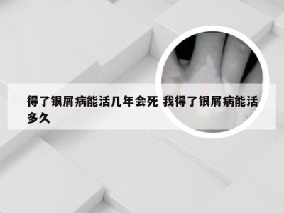 得了银屑病能活几年会死 我得了银屑病能活多久