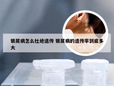 银屑病怎么杜绝遗传 银屑病的遗传率到底多大