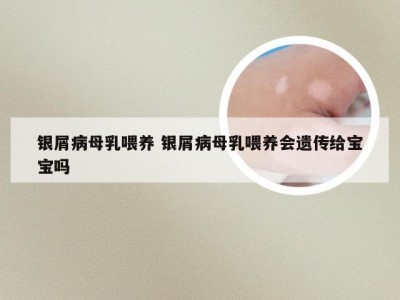 银屑病母乳喂养 银屑病母乳喂养会遗传给宝宝吗