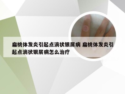 扁桃体发炎引起点滴状银屑病 扁桃体发炎引起点滴状银屑病怎么治疗