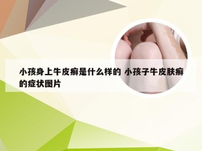 小孩身上牛皮癣是什么样的 小孩子牛皮肤癣的症状图片