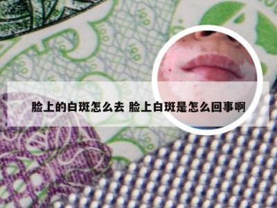 脸上的白斑怎么去 脸上白斑是怎么回事啊