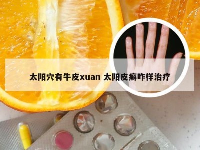 太阳穴有牛皮xuan 太阳皮癣咋样治疗