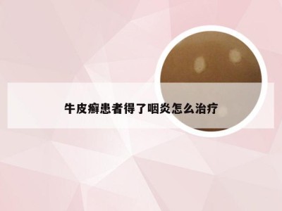 牛皮癣患者得了咽炎怎么治疗