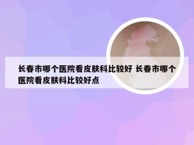 长春市哪个医院看皮肤科比较好 长春市哪个医院看皮肤科比较好点