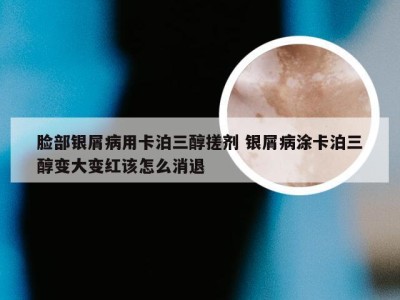 脸部银屑病用卡泊三醇搓剂 银屑病涂卡泊三醇变大变红该怎么消退