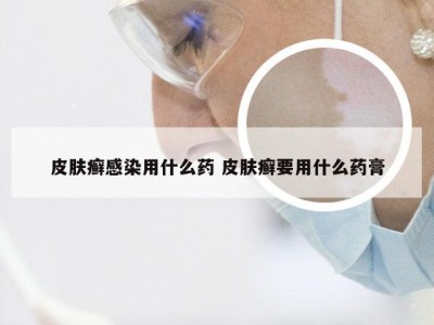 皮肤癣感染用什么药 皮肤癣要用什么药膏