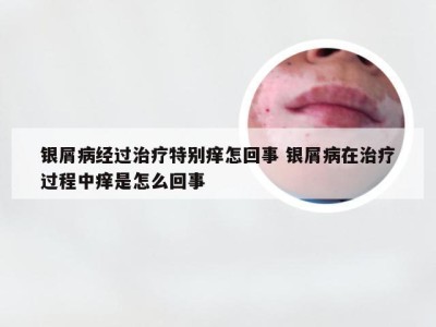 银屑病经过治疗特别痒怎回事 银屑病在治疗过程中痒是怎么回事