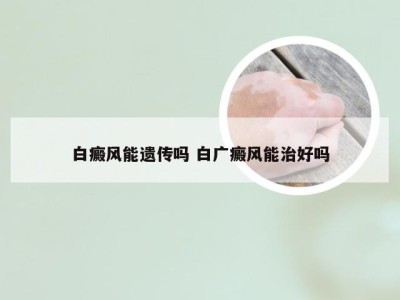 白癜风能遗传吗 白广癜风能治好吗