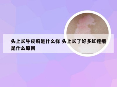 头上长牛皮癣是什么样 头上长了好多红疙瘩是什么原因