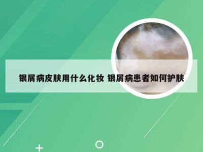 银屑病皮肤用什么化妆 银屑病患者如何护肤