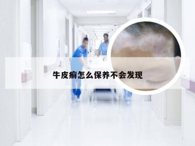 牛皮癣怎么保养不会发现