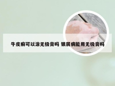 牛皮癣可以涂无极膏吗 银屑病能用无极膏吗