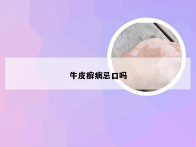 牛皮癣病忌口吗