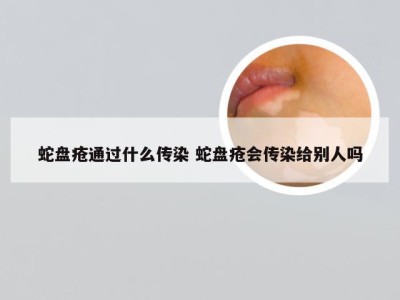 蛇盘疮通过什么传染 蛇盘疮会传染给别人吗