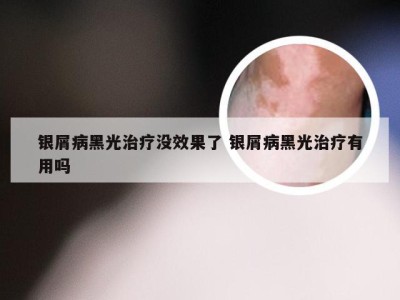 银屑病黑光治疗没效果了 银屑病黑光治疗有用吗