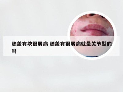 膝盖有块银屑病 膝盖有银屑病就是关节型的吗