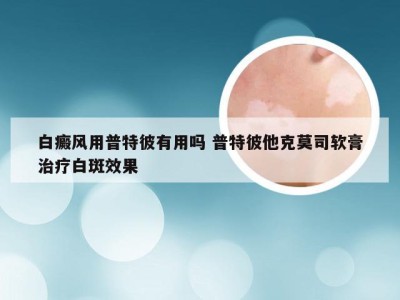 白癜风用普特彼有用吗 普特彼他克莫司软膏治疗白斑效果