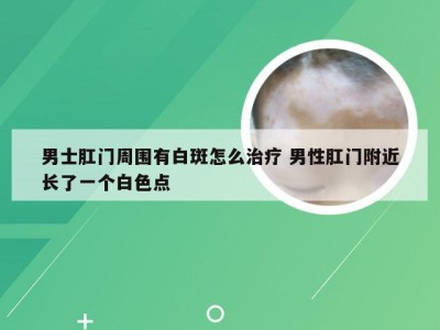 男士肛门周围有白斑怎么治疗 男性肛门附近长了一个白色点