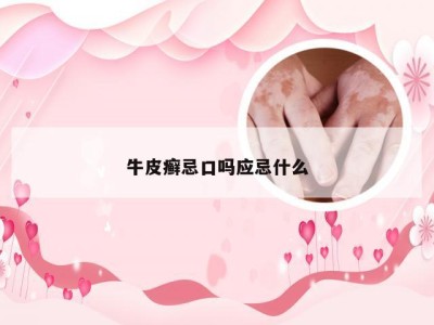 牛皮癣忌口吗应忌什么