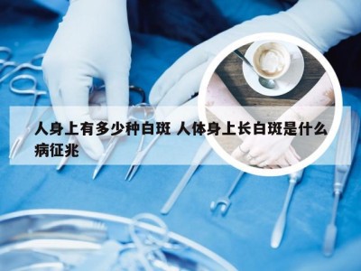 人身上有多少种白斑 人体身上长白斑是什么病征兆