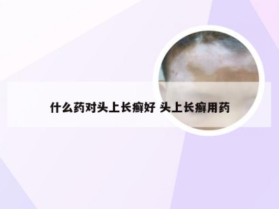 什么药对头上长癣好 头上长癣用药