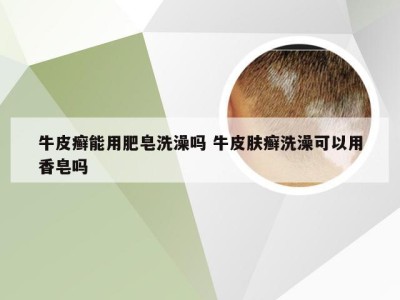 牛皮癣能用肥皂洗澡吗 牛皮肤癣洗澡可以用香皂吗