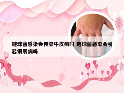 链球菌感染会传染牛皮癣吗 链球菌感染会引起银屑病吗