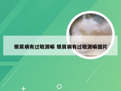 银屑病有过敏源嘛 银屑病有过敏源嘛图片