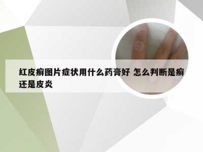 红皮癣图片症状用什么药膏好 怎么判断是癣还是皮炎