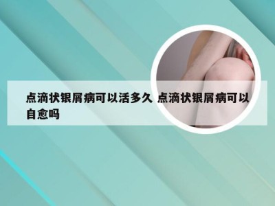 点滴状银屑病可以活多久 点滴状银屑病可以自愈吗