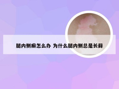 腿内侧癣怎么办 为什么腿内侧总是长藓