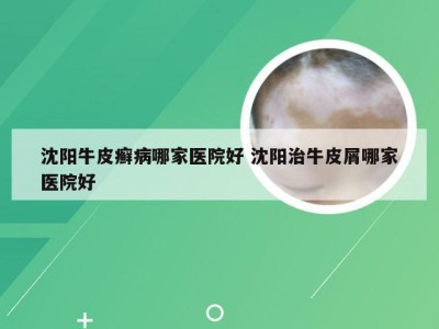 沈阳牛皮癣病哪家医院好 沈阳治牛皮屑哪家医院好